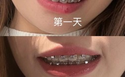 牙齿缝大怎么矫正？有哪些有效矫正方法？