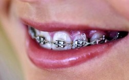 钢丝矫正牙齿，钢丝究竟是如何一步步移动牙齿的？