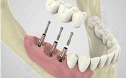 罗湖植牙哪里好？这么多机构怎么选才靠谱？