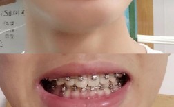 牙齿矫正钢丝脱落了，该怎么处理？