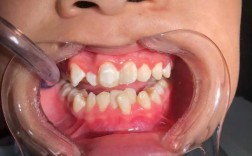 矫正牙齿后牙齿变弯？背后原因究竟是什么？