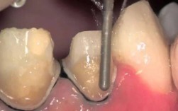 牙冠肩台预备方法的关键步骤与注意事项是什么？