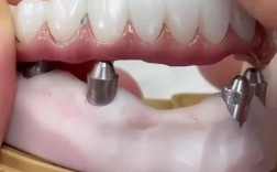 种牙临时牙冠戴法