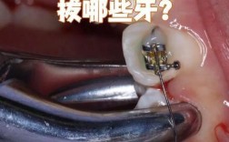 牙齿矫正拔牙？哪种情况必须拔？