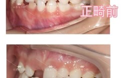 矫正中牙齿有缝是正常现象吗？该怎么处理？