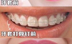 牙齿矫正就是戴牙套？矫正方式不止这些吧？