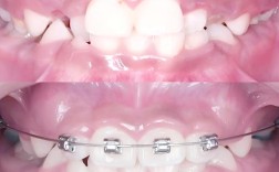 国外牙齿矫正技术有哪些独特优势值得关注？