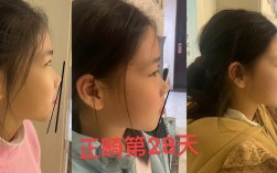 正畸口外弓睡觉时能直接戴着睡吗？需要固定装置防止脱落吗？侧睡会不会压到脸颊影响矫正效果？