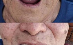 满口无牙做种植牙，究竟需要种几颗才合适？