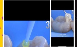 嵌体泥使用时材料调拌比例和操作步骤有哪些注意事项？如何确保嵌体与窝洞边缘密合且避免气泡产生？