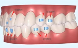 正畸颊侧粘扣子