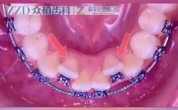 美容冠矫正牙齿的具体过程是怎样的？