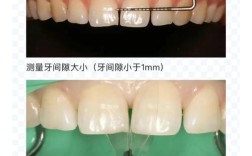 矫正牙齿能关闭牙缝吗？具体方法和效果如何？