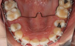 正畸TPA的英文是什么？它的全称又是什么？