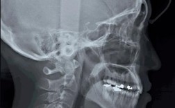 牙齿正畸为何必拍头颅侧位片？它有何关键作用？