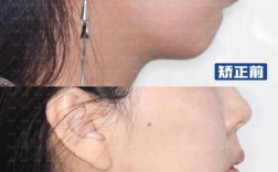 武汉凸嘴正畸牙齿，矫正效果如何？能改善凸嘴吗？