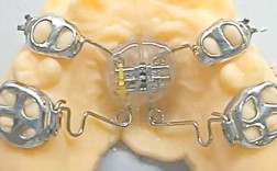 支抗磨牙后移的有效方法有哪些？