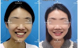 骨性露龈笑正畸矫正效果如何？