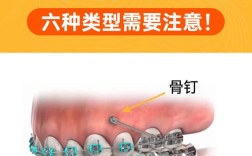 正畸支抗钉松动了怎么办？别慌，这样处理矫正不受影响