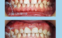 正畸磨牙近移间隙关闭，如何高效精准实现？