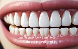 牙齿中间有缝能矫正吗
