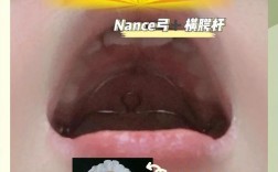 正畸腭弓的作用