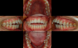 北大口腔成人正畸效果如何？适合哪些情况做？
