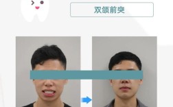 牙槽骨突出手术方法有哪些？不同术式的适应症、优缺点、术后恢复期及风险因素如何科学选择与评估？