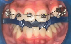 普特正畸托槽材料好不好？效果、舒适度如何？