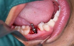 欧洲牙钉种牙效果究竟如何？靠谱吗？