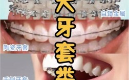 牙齿矫正器有哪些？常见类型怎么选？