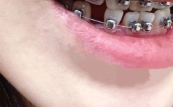 矫正牙齿加力时痛得厉害，这是正常现象吗？