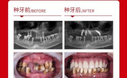 半口牙即种即用