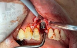 第一期植牙失败，究竟是什么原因？后续治疗该如何补救？