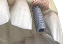 种牙骨究竟是什么样子的？种植牙手术中骨头的真实形态与结构解析