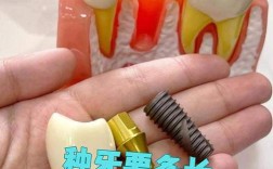 植完牙体后一般需要多久才能戴上牙冠？