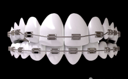 苏州金属牙矫正效果如何？价格与优缺点有哪些？