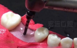 最新植牙技术视频