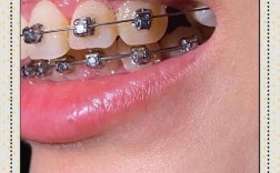 哺乳期矫正牙齿安全吗？