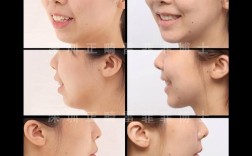 牙齿正畸手术案例