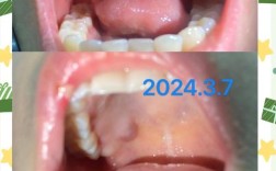 正畸上颚粘的东西是什么？有何作用？