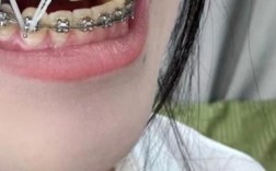 矫正牙齿后出现缝隙