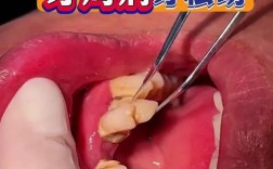 正畸后牙齿松动伴随发炎，是正常反应还是异常情况？