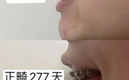 杭州畸形牙齿矫正效果怎样？哪种方法靠谱？