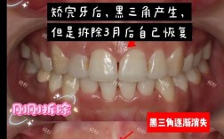牙齿矫正黑三角图片