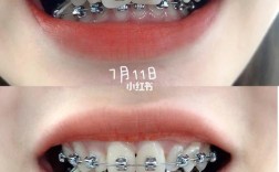 24岁矫正牙齿还来得及吗？