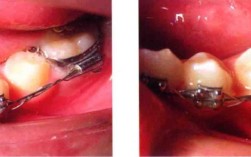 正畸结扎丝对折结扎