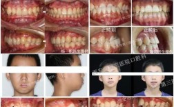 正畸中线为何越来越歪？是正常现象还是需调整？