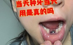 种牙真实经历分享，过程到底疼不疼效果好不好？