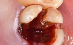 蛀牙拔掉后，种牙是必须的吗？有哪些注意事项？